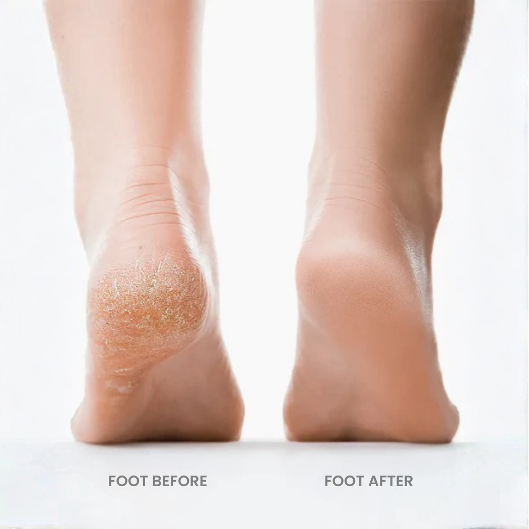 TheLustreskin™ Pedicure Automatic Foot Grinder